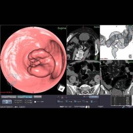 CT-colonography