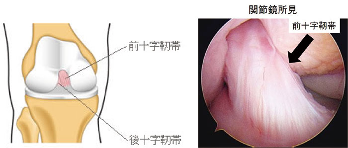 帯広厚生病院 ｜ 膝のけがについて 前十字靱帯、半月板に対しての取り組み（スポーツ外傷）