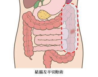 結腸左半切除術