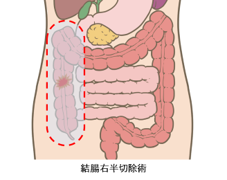 結腸右半切除術